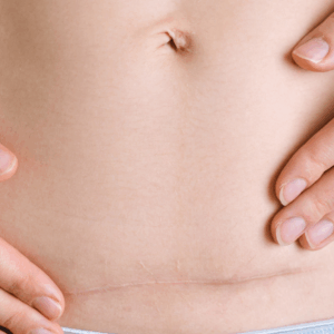 Kaiserschnittnarbe, Kaiserschnitt, Bauchgeburt